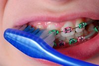 Braces Care - Orthodontist in Rome and Cedartown, GA