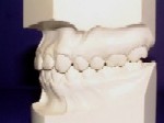 Class I - Malocclusion