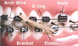 Orthodontic Terms - Orthodontist in Rome and Cedartown, GA